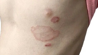 Микоз тела: признаки и диагностика заболевания