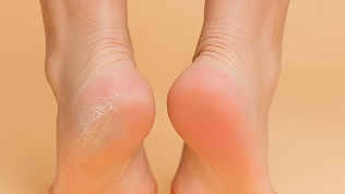 Грибок кожи: причины и факторы риска заражения