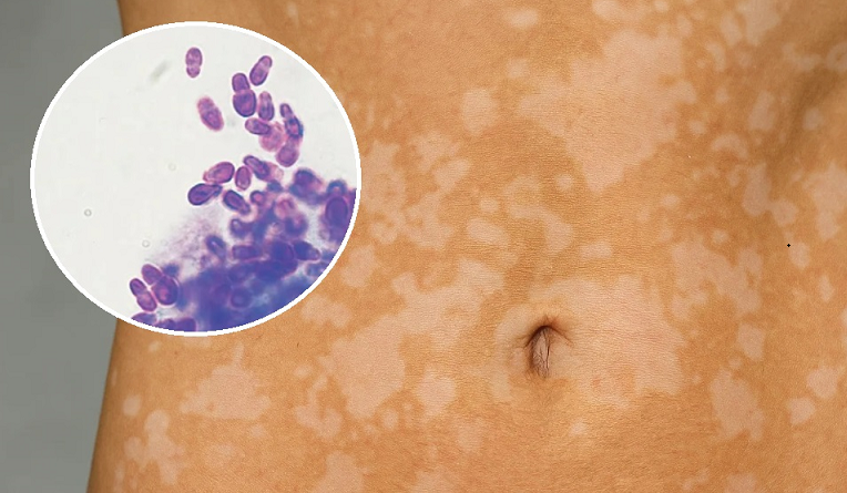 Дрожжевые инфекции