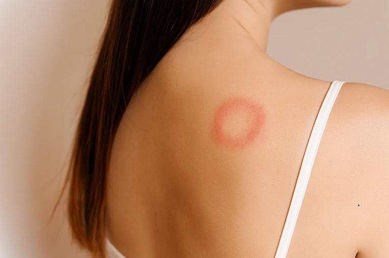 Грибок кожи