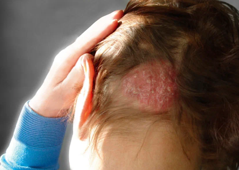 Дерматомикоз