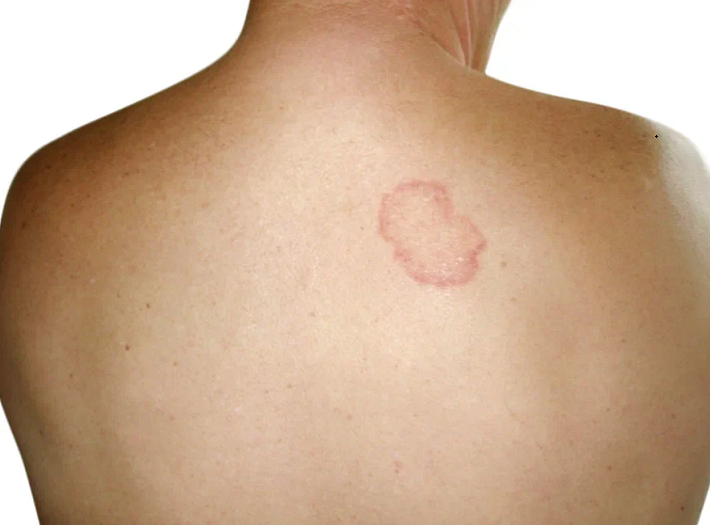 Микроспория