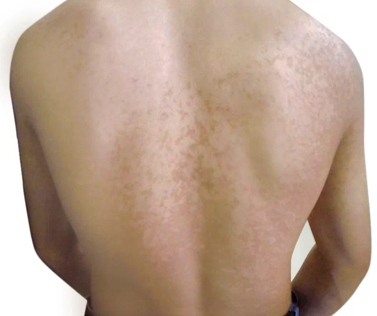 Разноцветный лишай